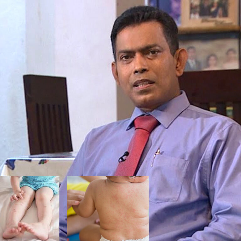 දරුවන් අතර ඉන්ෆ්ලුවන්සා. චිකුන්ගුන්යා සහ ඩෙංගු වැඩිවීමක් වාර්තා වෙනවා – විශේෂඥ වෛද්‍ය දීපාල් පෙරේරා